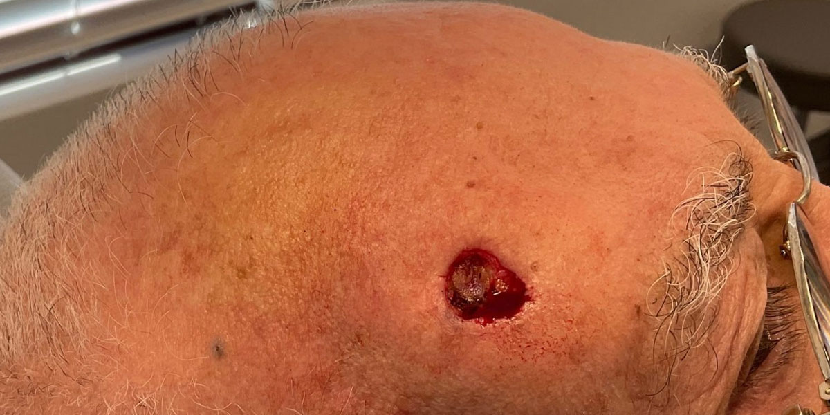 example 3 Basal cell carcinoma of skin