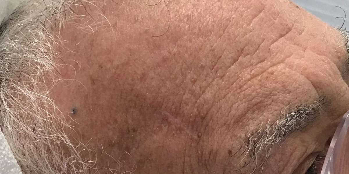 example 3 after 2 months Squamous cell carcinoma in situ