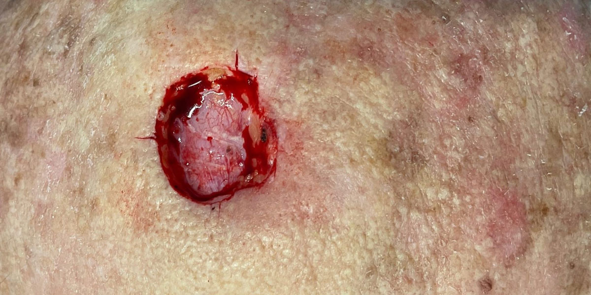 example 4 SCC Squamous cell carcinoma of skin