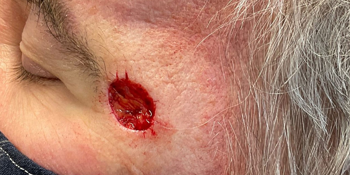 example 6 Squamous cell carcinoma in situ