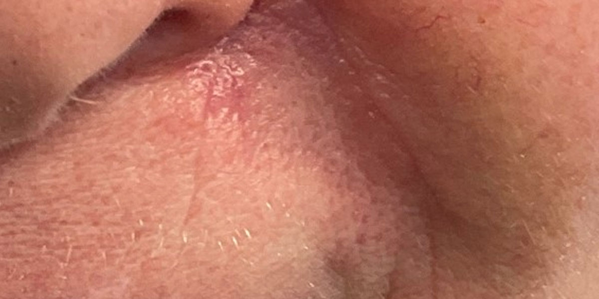 example 9 after 6 weeks Follow Up