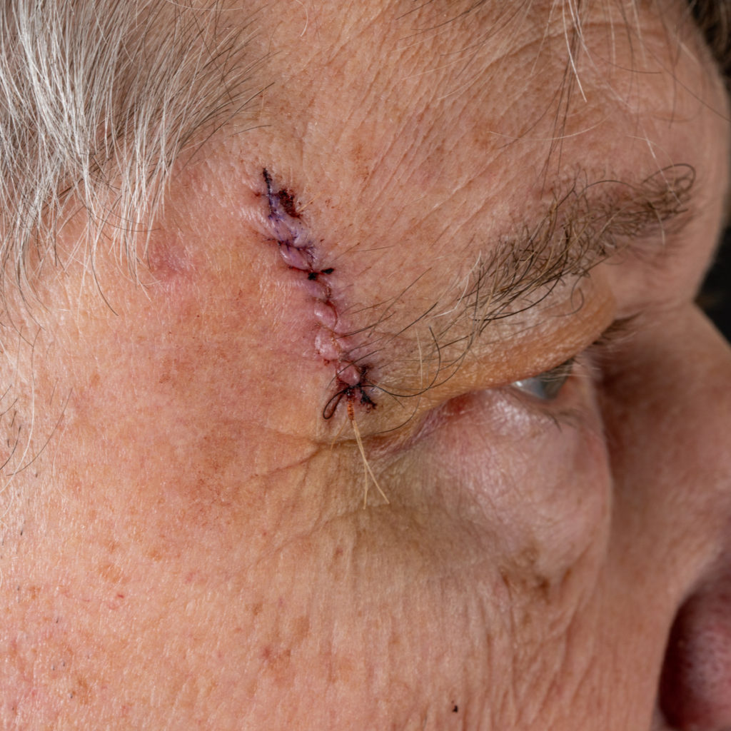 mohs surgery levittown pa