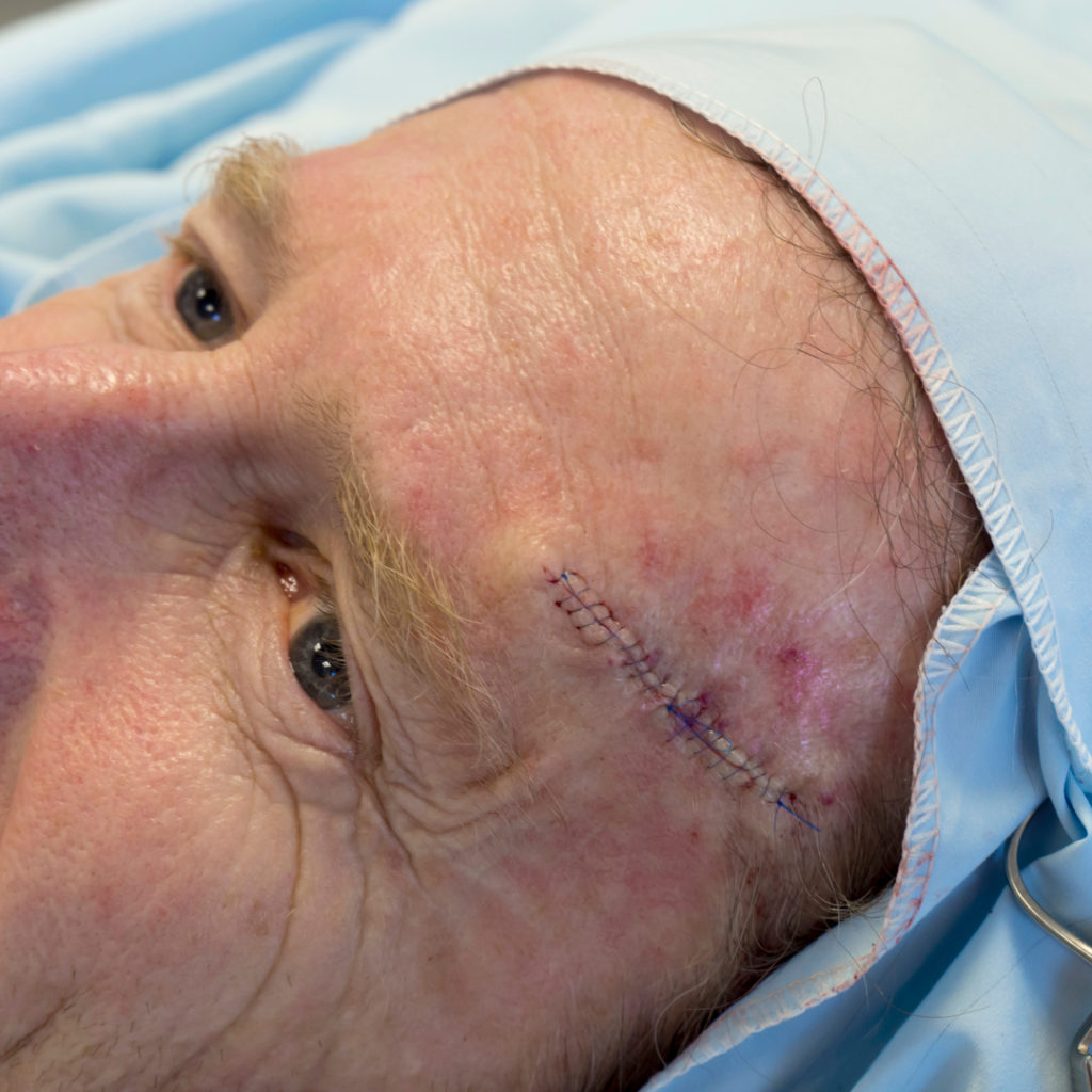 mohs surgery newtown pa