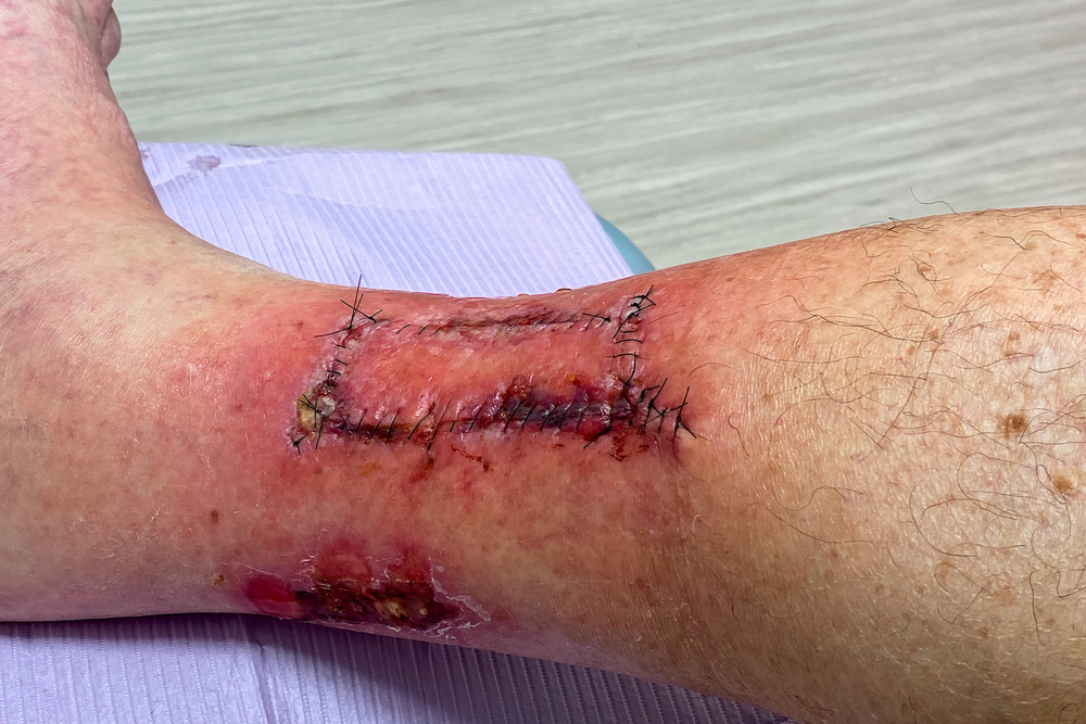 mohs surgery warrington