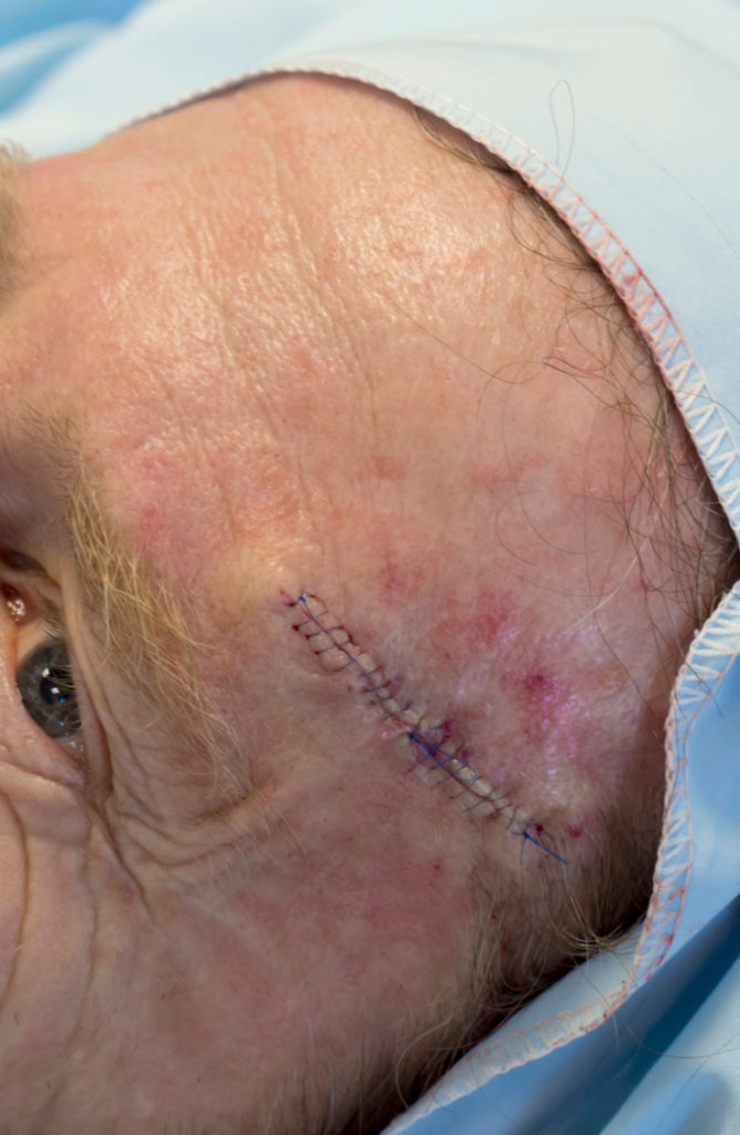 mohs surgery willow grove