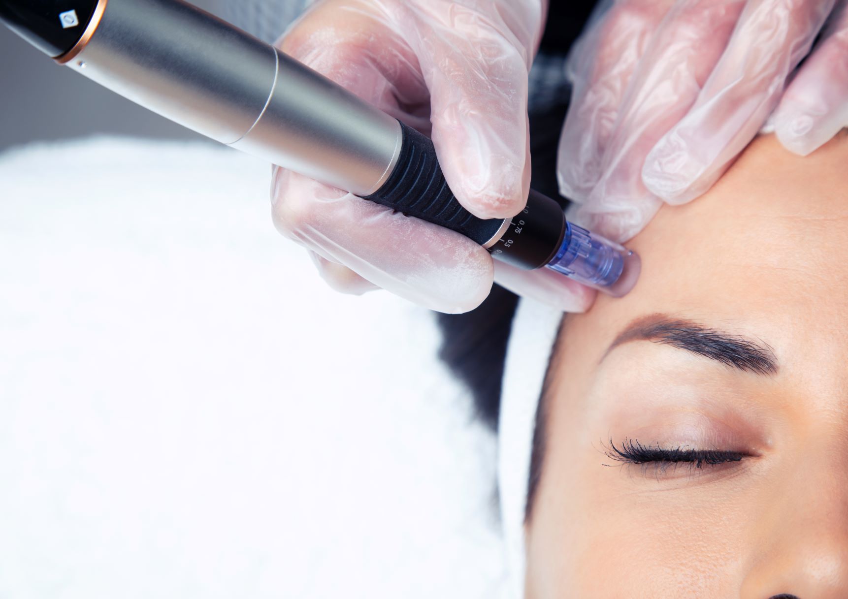 3 Benefits of Micro Needling