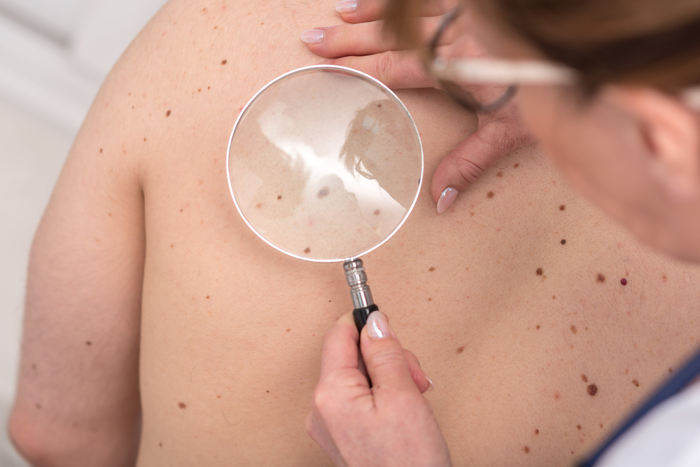 5 Non-Invasive Treatments for Dark Spots