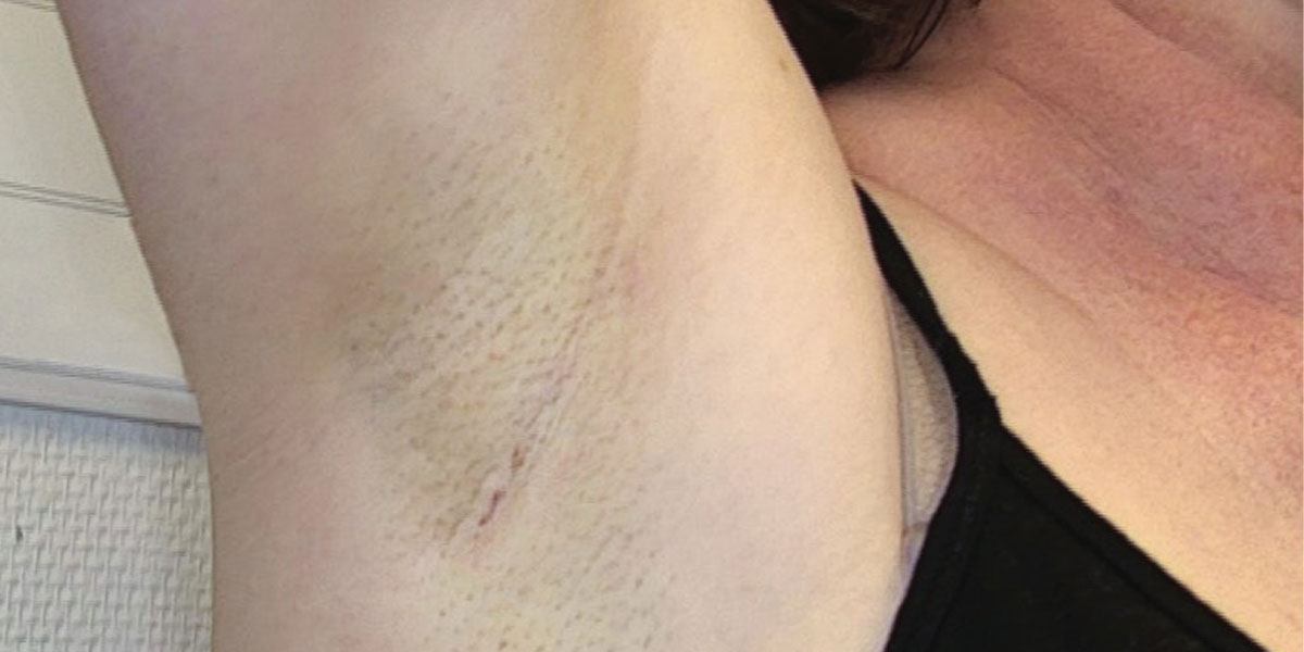 Hidradenitis Suppurativa after ex2
