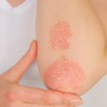 Tips On Treating Psoriasis In The Summer