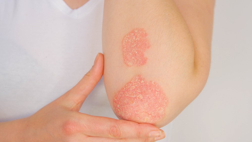 Tips On Treating Psoriasis In The Summer