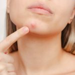 Dealing with Adult Acne How Your Diet Can Lead to Acne