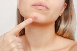 Dealing with Adult Acne How Your Diet Can Lead to Acne