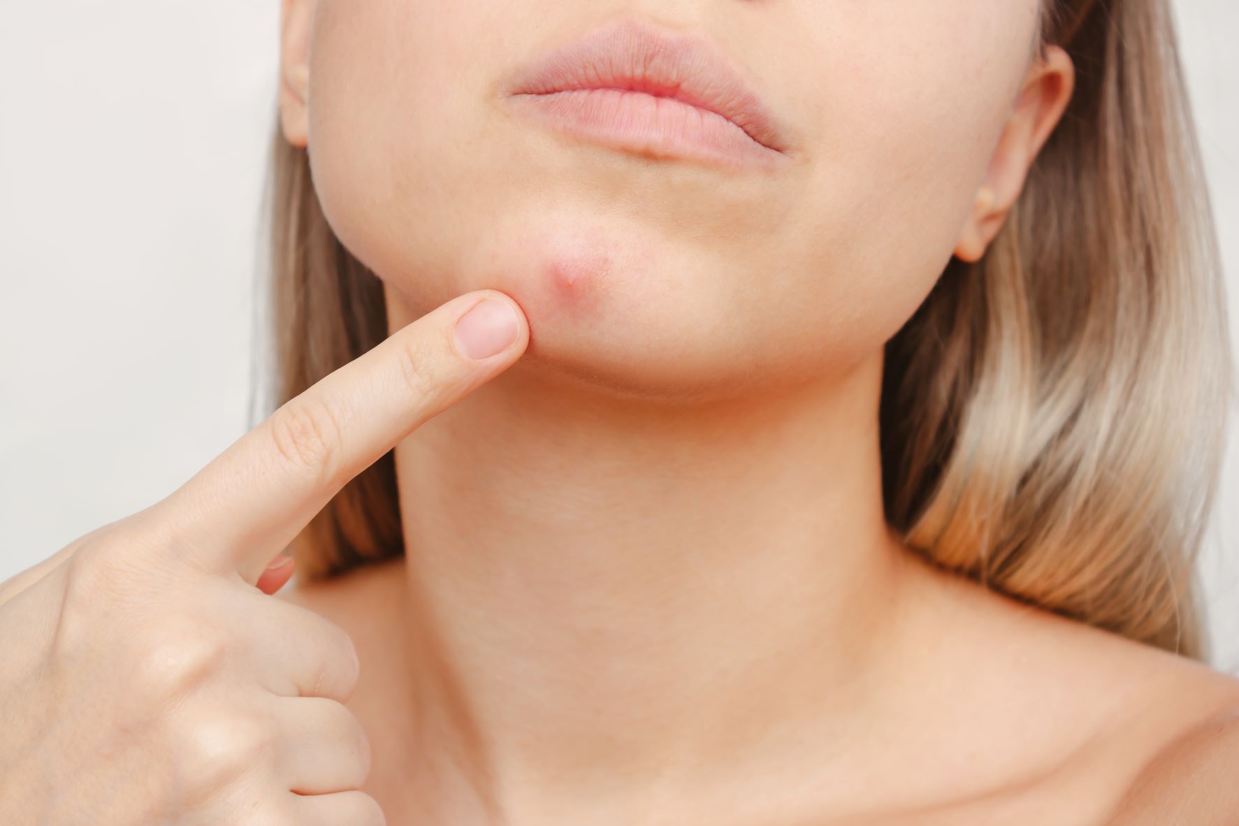 Dealing with Adult Acne How Your Diet Can Lead to Acne