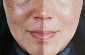 Best In-Office Treatments For Melasma
