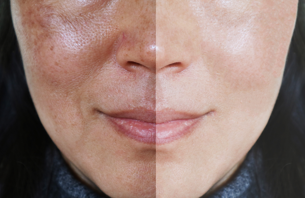 Best In-Office Treatments For Melasma