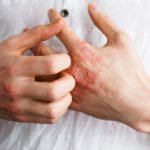 Eczema Preventative Care Tips to Avoid Winter Flare-Ups