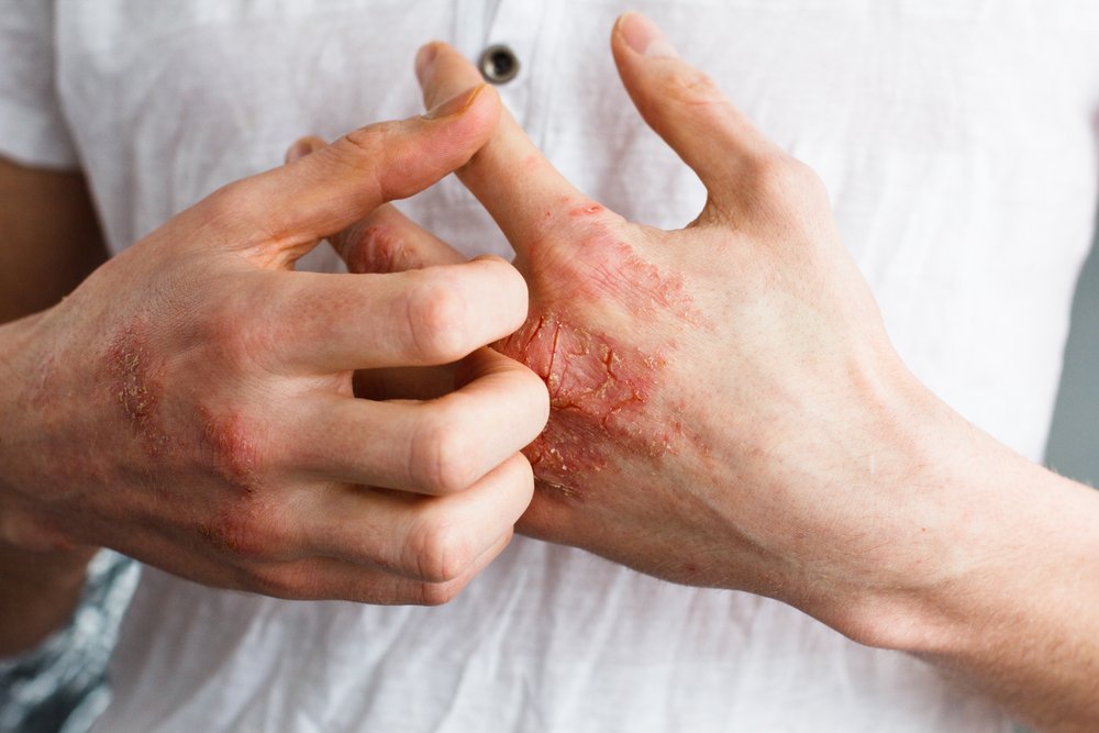 Eczema Preventative Care Tips to Avoid Winter Flare-Ups