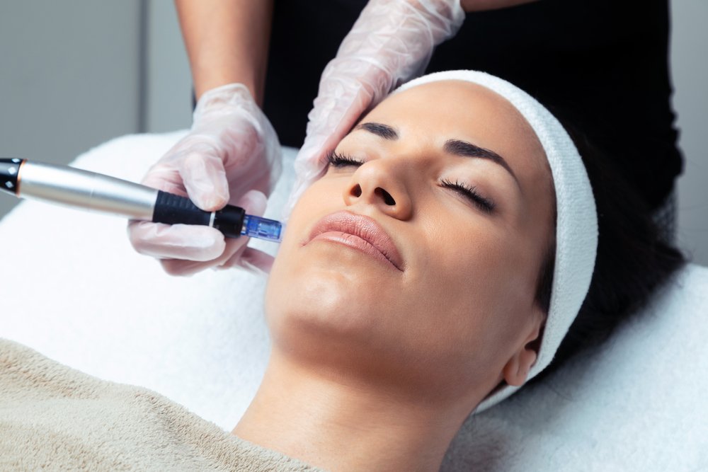 How Microneedling Can Improve The Appearance Of Your Skin