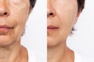 The Differences Between Types Of Fillers