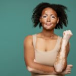 Treatment Options for Vitiligo