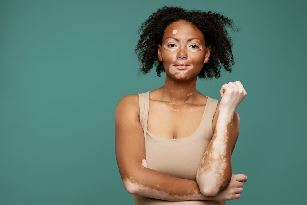 Treatment Options for Vitiligo