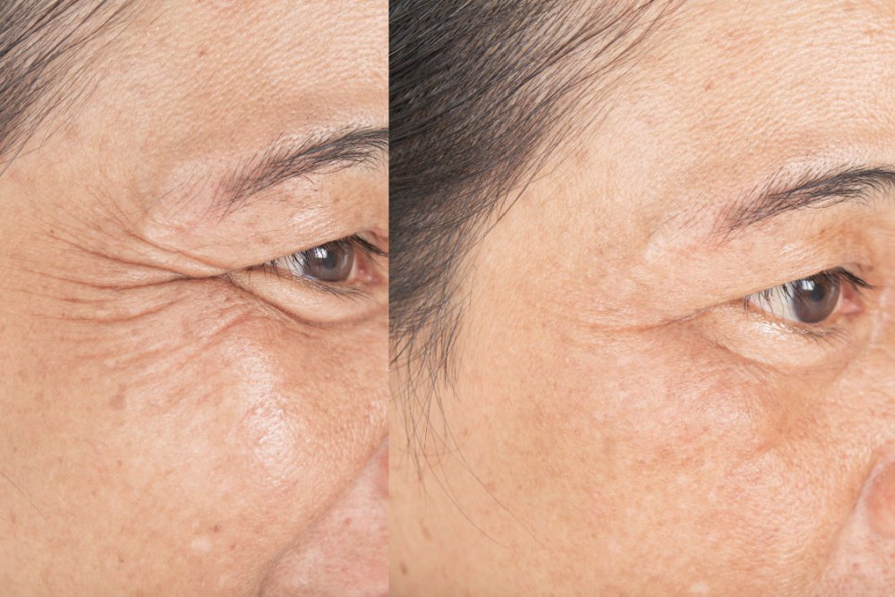 CO2 Resurfacing For Wrinkles