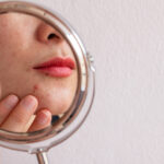 Adult Acne: Causes & Treatment Options