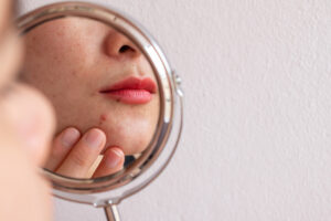 Adult Acne: Causes & Treatment Options