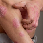 At-Home Psoriasis Care & When To See A Dermatologist