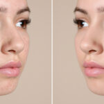 acne scarring
