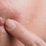 Cyst vs. Pimple: What’s The Difference?