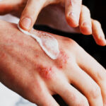 At-Home Eczema Care Tips that Can Help You Soothe the Itch