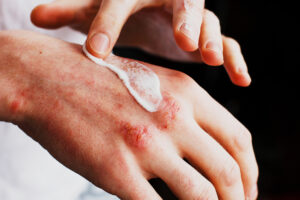 At-Home Eczema Care Tips that Can Help You Soothe the Itch