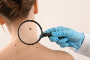 Knowing the Signals: 5 Signs Your Mole Might Be Cancerous