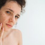 Hormonal Acne After 30: Why Your Skin Changed and What Dermatologists Recommend Now
