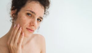 Hormonal Acne After 30: Why Your Skin Changed and What Dermatologists Recommend Now