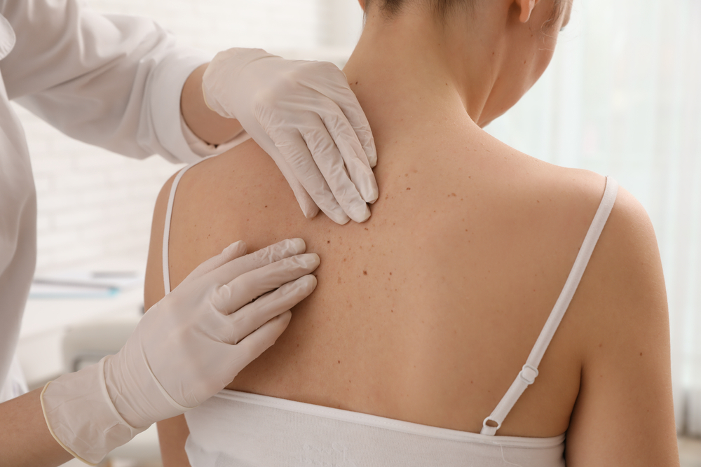 Skin Cancer Screening: How Often Should You Really Get Checked?