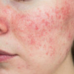 Managing the Flush: A Guide to Stopping Rosacea Flare-Ups