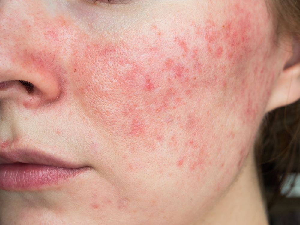 Managing the Flush: A Guide to Stopping Rosacea Flare-Ups