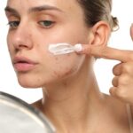 Effective Acne Scar Removal: How to Get Rid of Acne Scars Without Laser Treatment