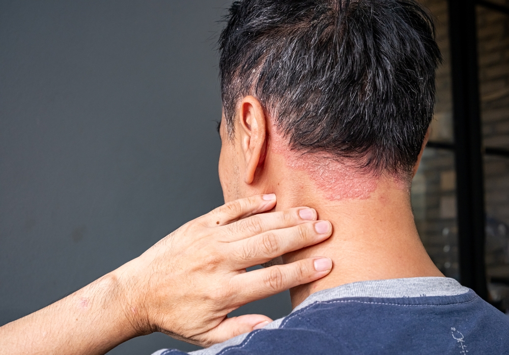 Psoriasis Scale Removal: Understanding Plaques and Buildup